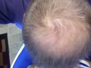 image of new hair after Profollica use